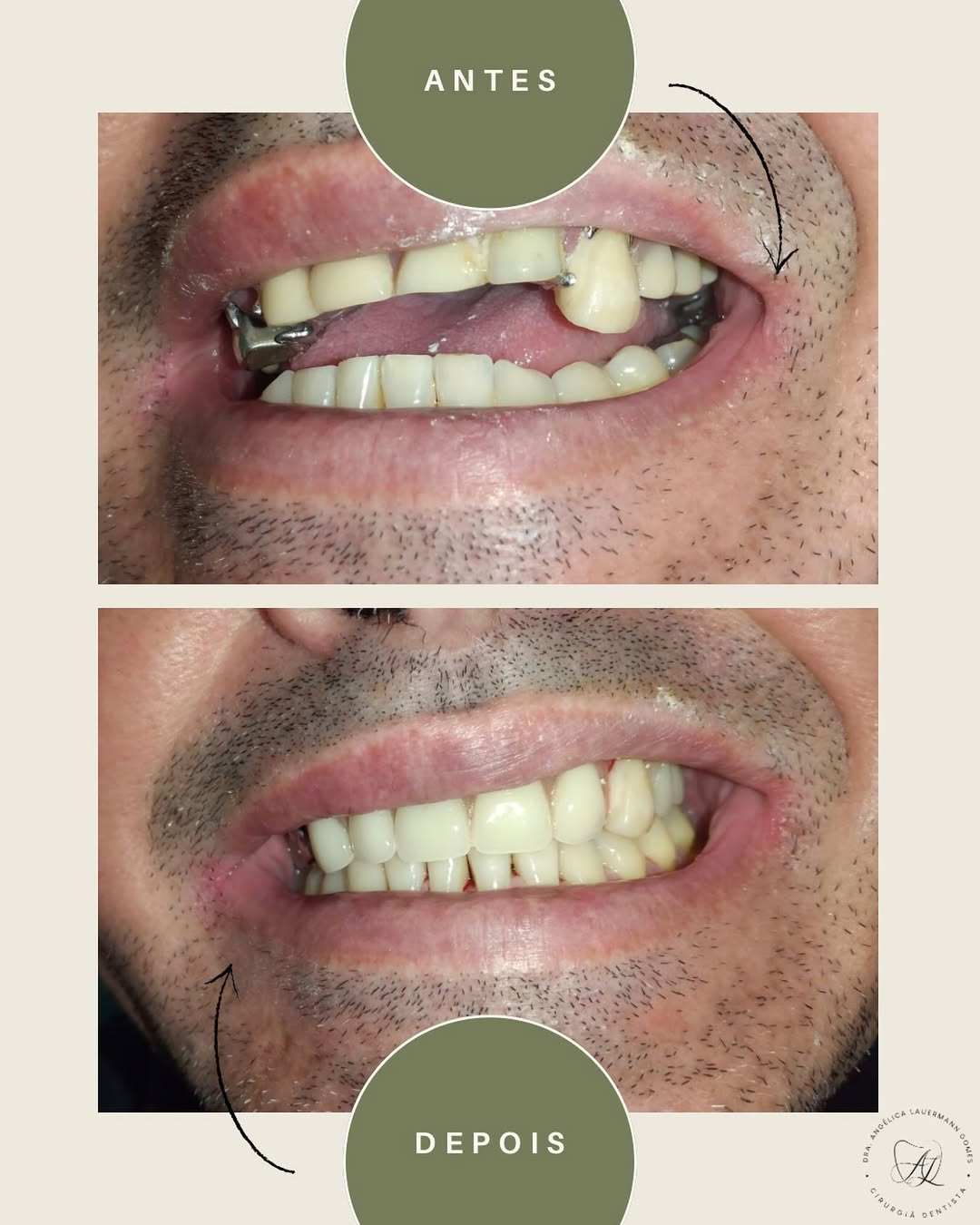 Reabilitação com Prótese (antes e depois)
